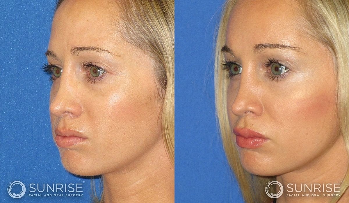Brow Lift Before & After