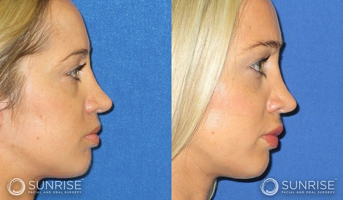 Brow Lift Before & After