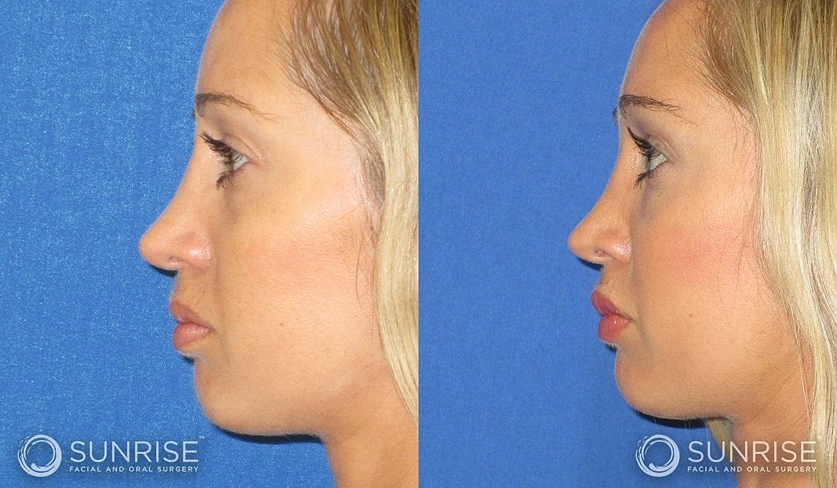 Brow Lift Before & After