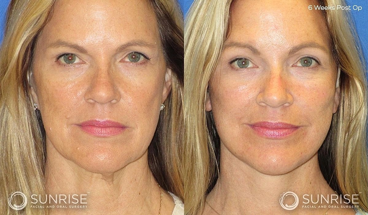 Brow Lift Before & After