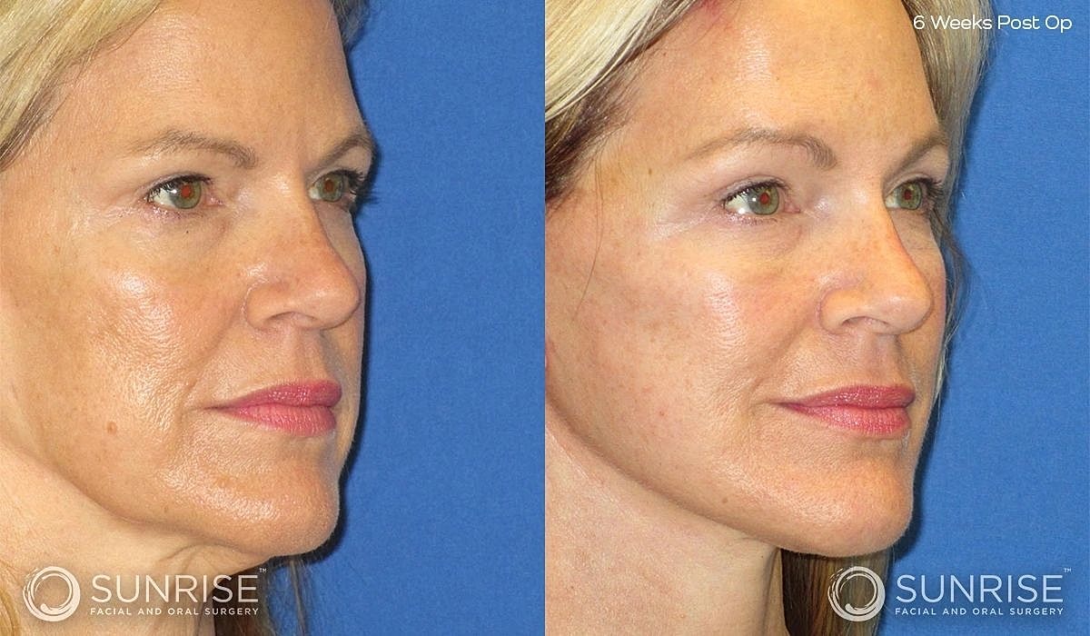 Brow Lift Before & After