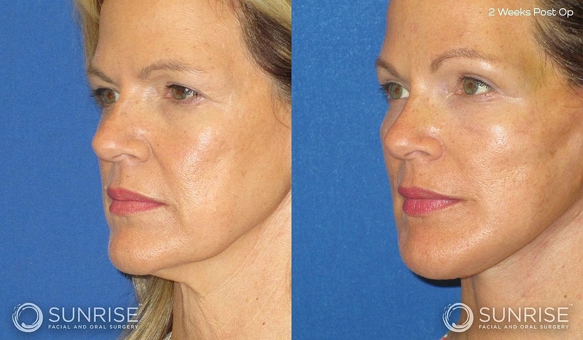 Brow Lift Before & After