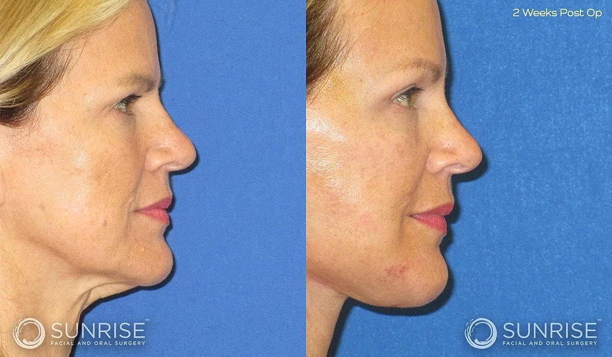 Brow Lift Before & After