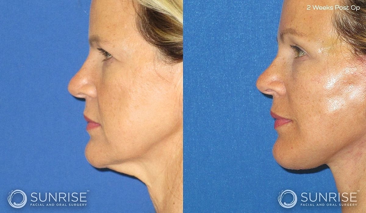 Brow Lift Before & After