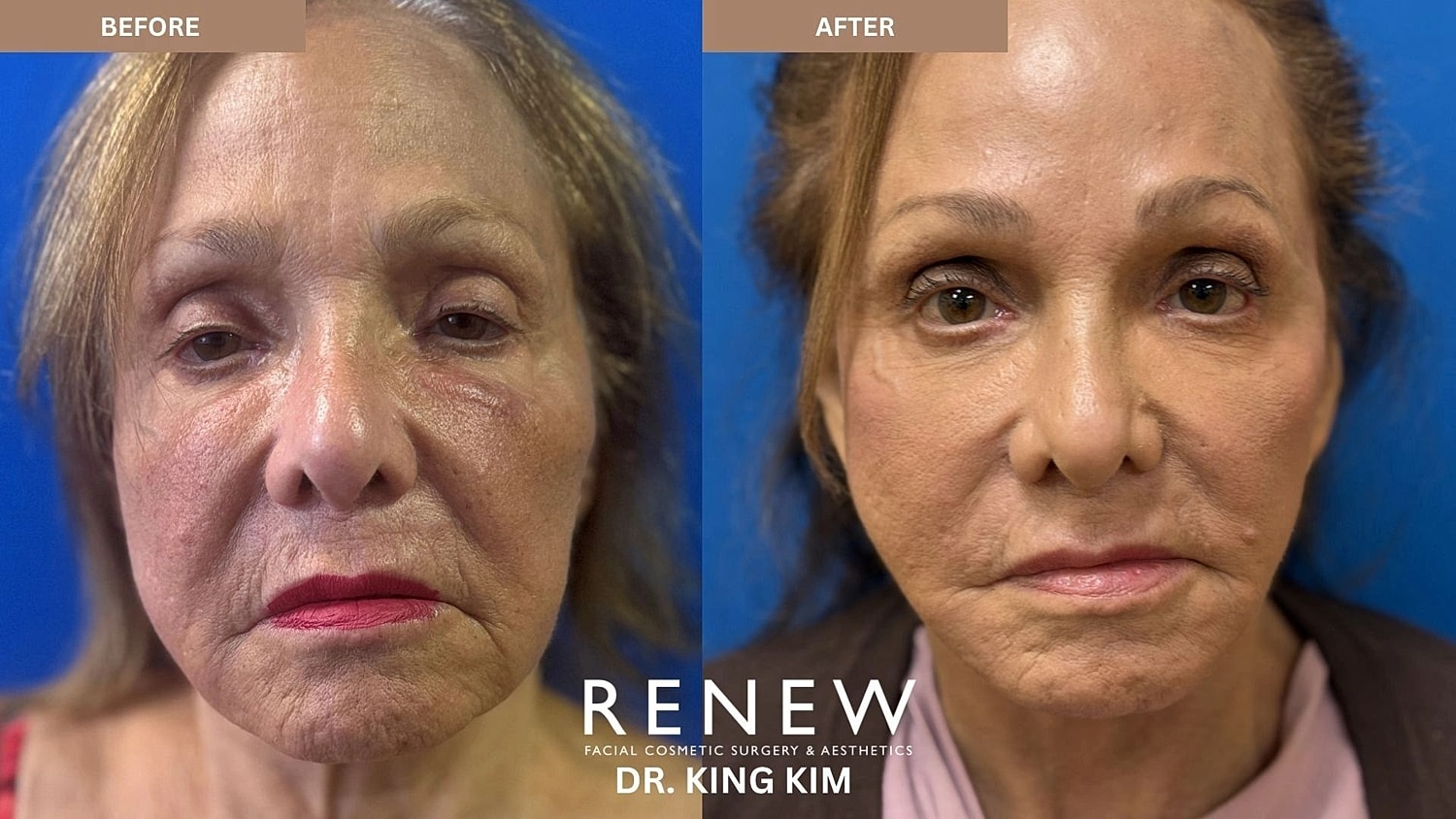 Brow Lift Before & After