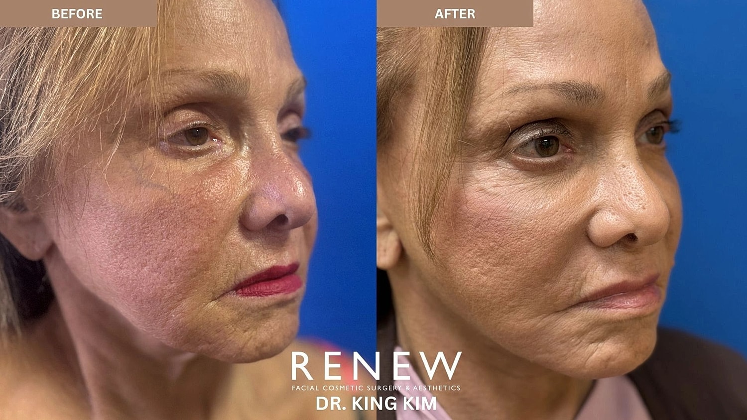 Brow Lift Before & After