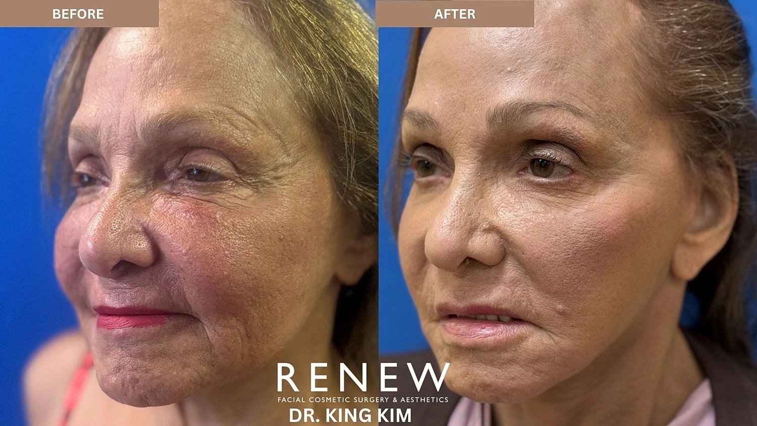 Brow Lift Before & After