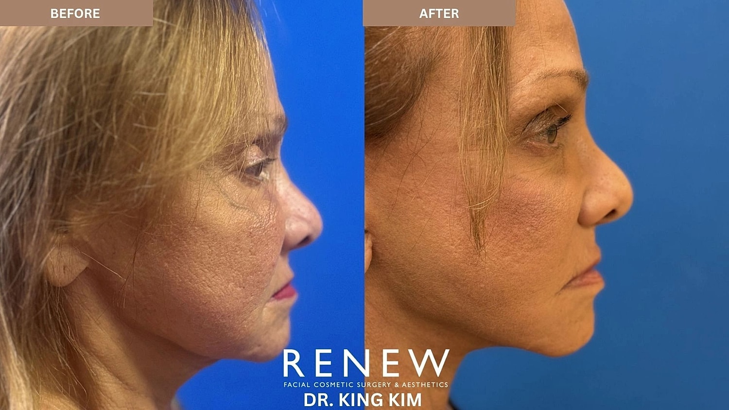 Brow Lift Before & After