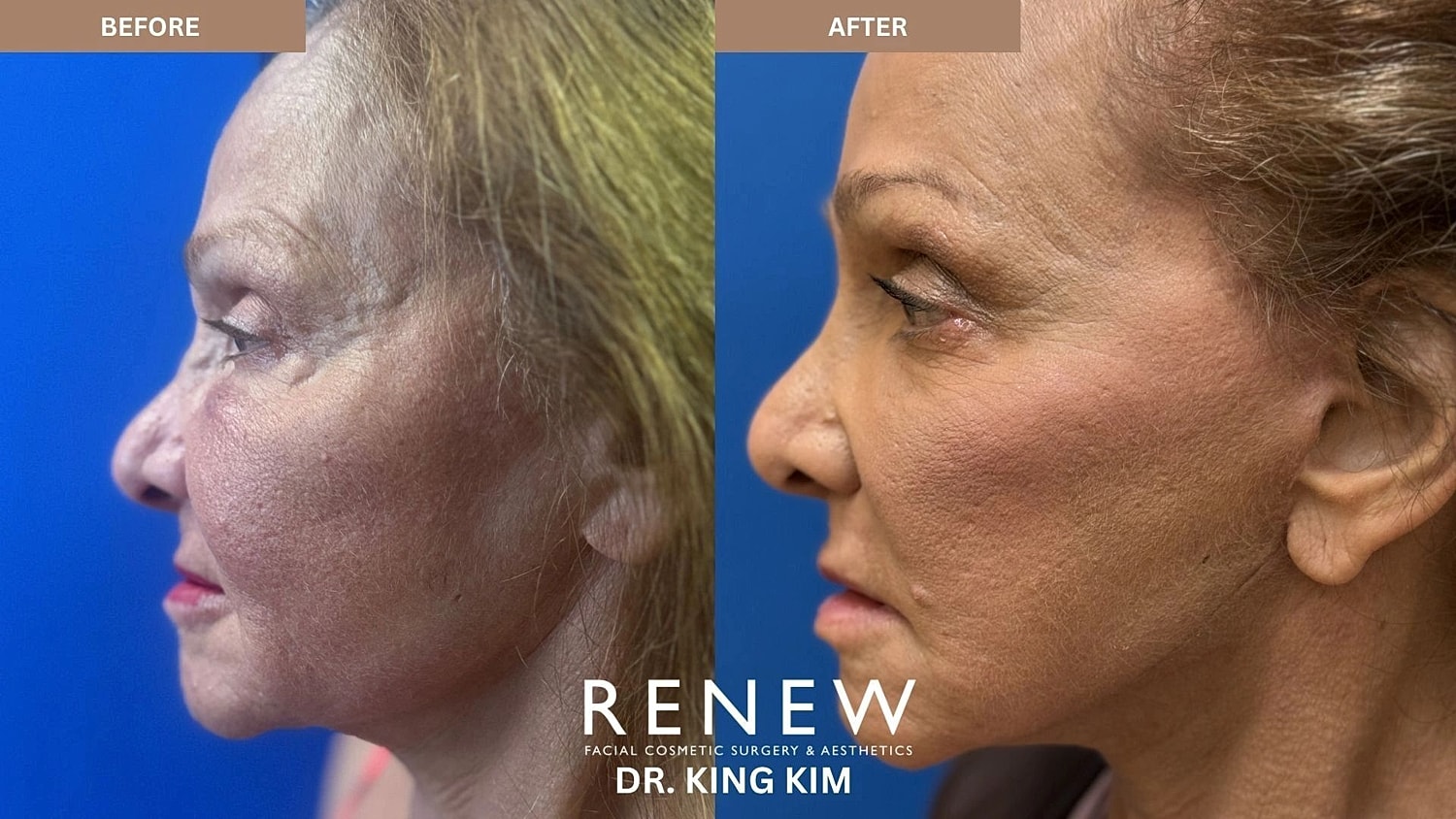 Brow Lift Before & After