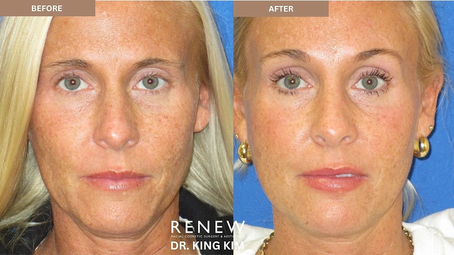Brow Lift Before & After