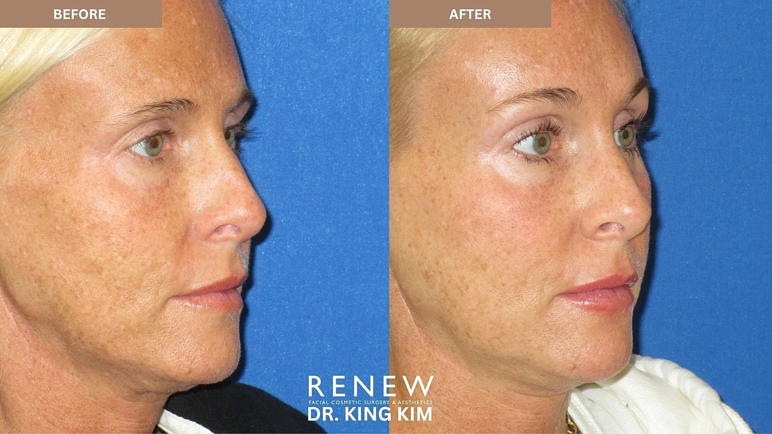 Brow Lift Before & After
