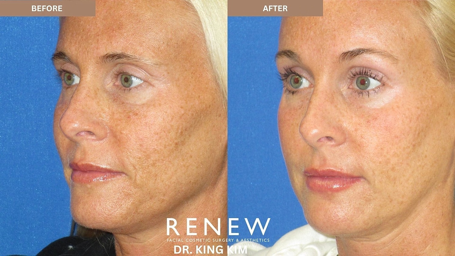 Brow Lift Before & After