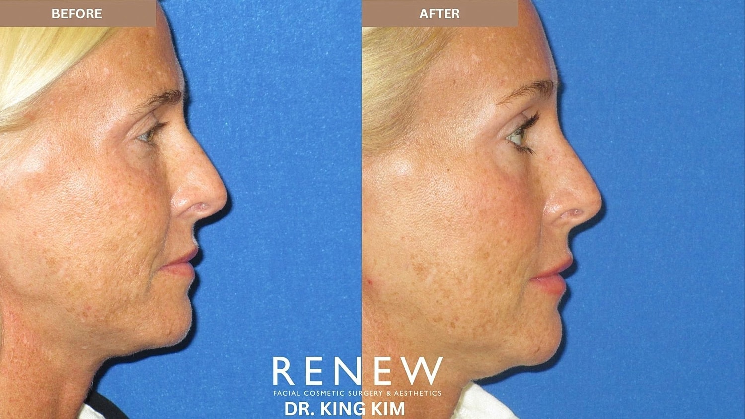 Brow Lift Before & After