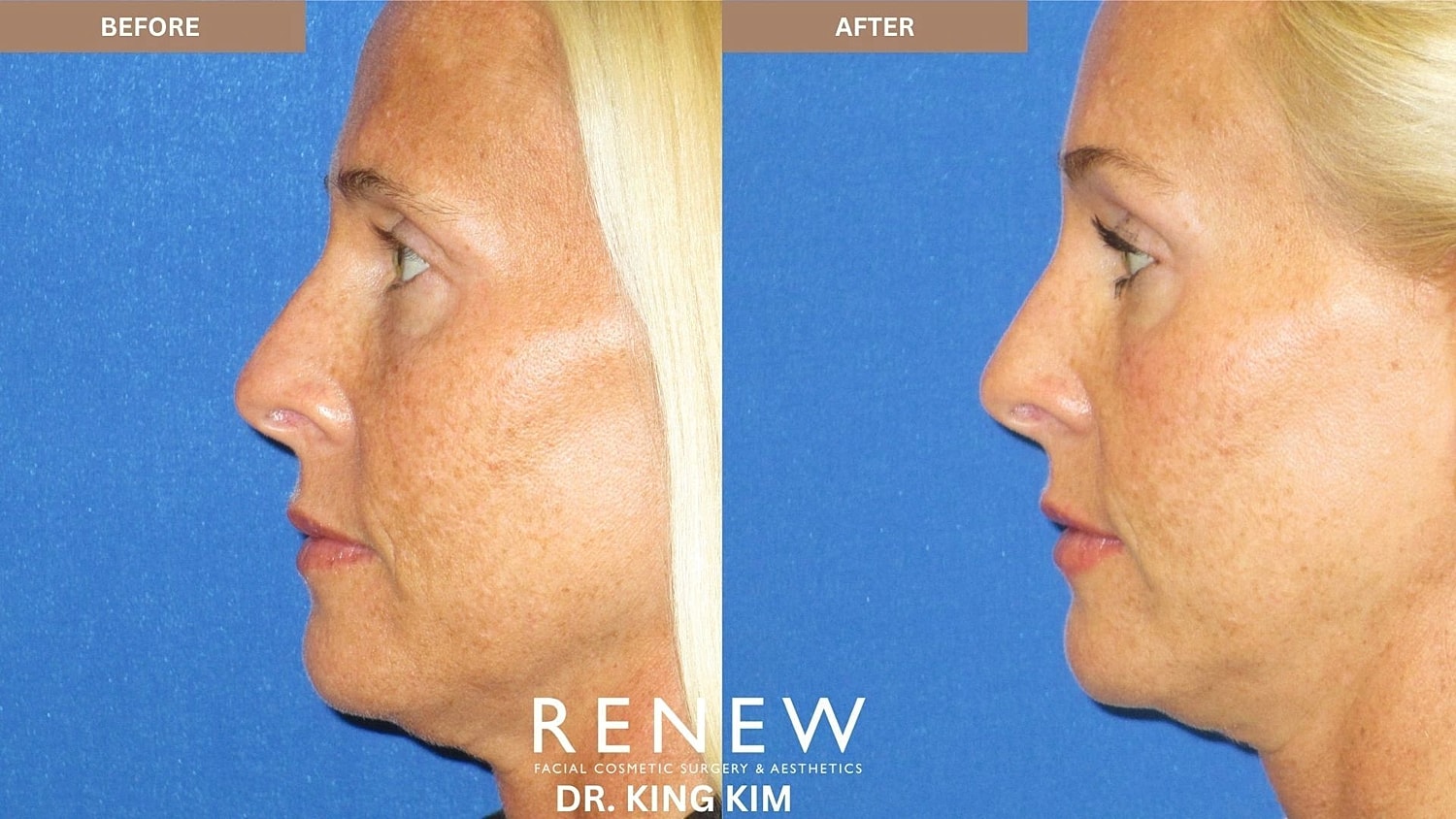 Brow Lift Before & After