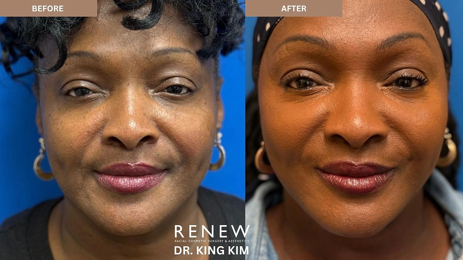 Brow Lift Before & After