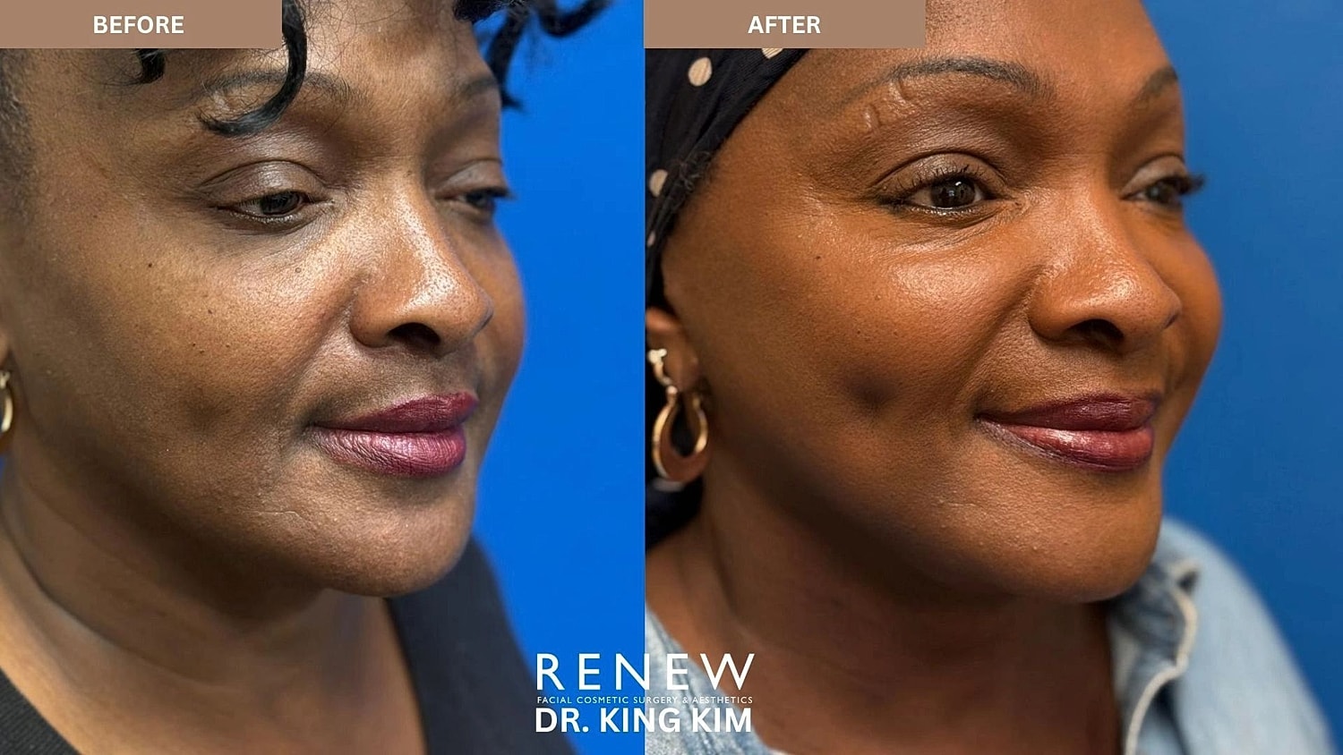Brow Lift Before & After