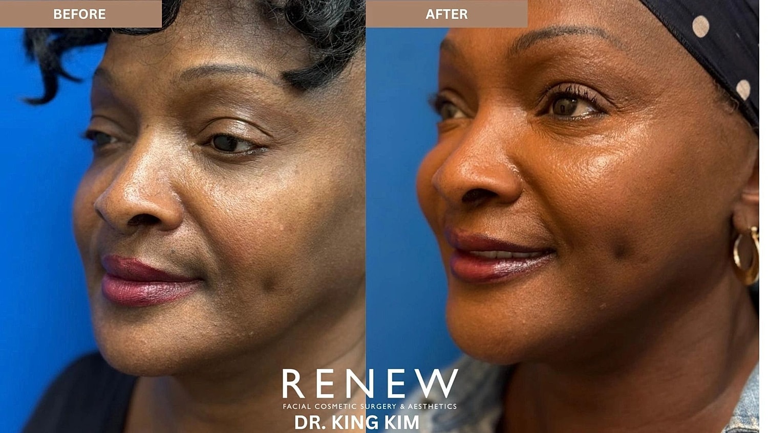 Brow Lift Before & After