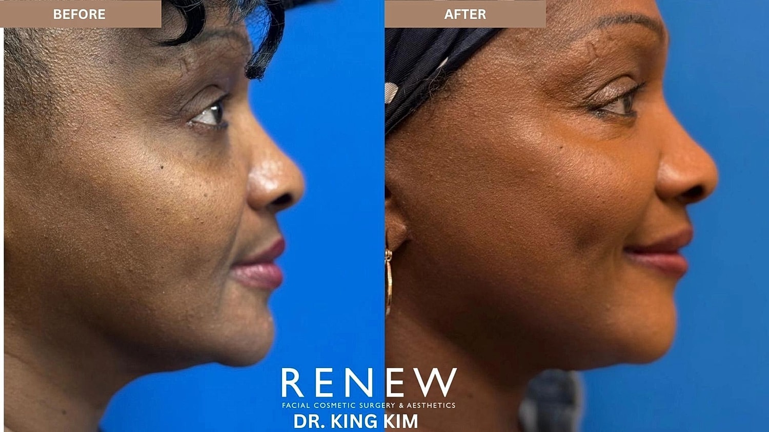 Brow Lift Before & After