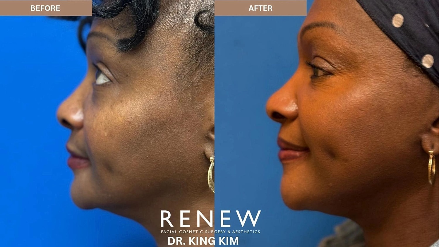 Brow Lift Before & After