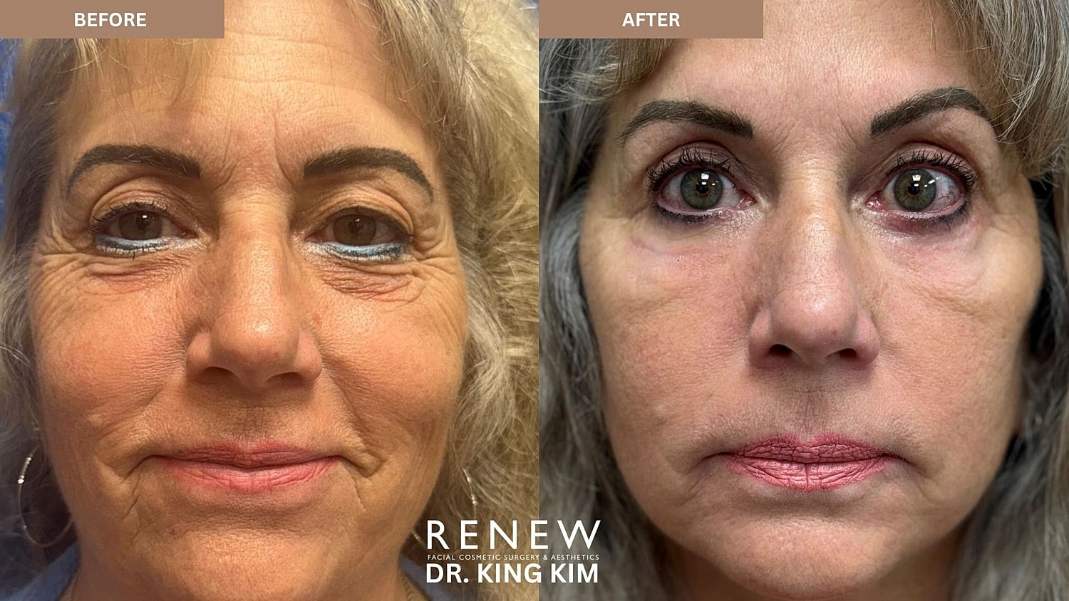 Brow Lift Before & After