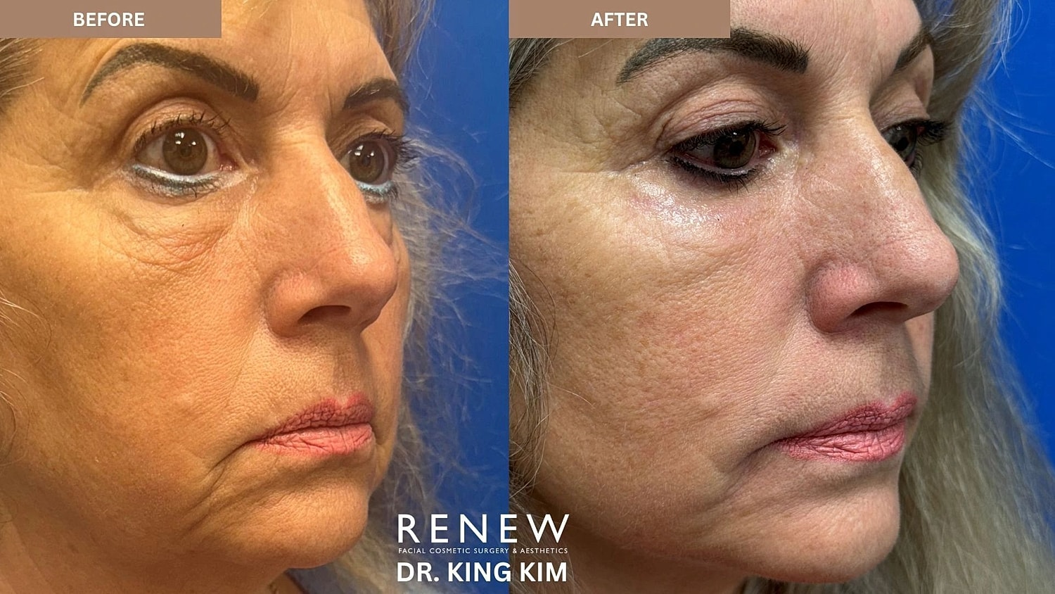 Brow Lift Before & After