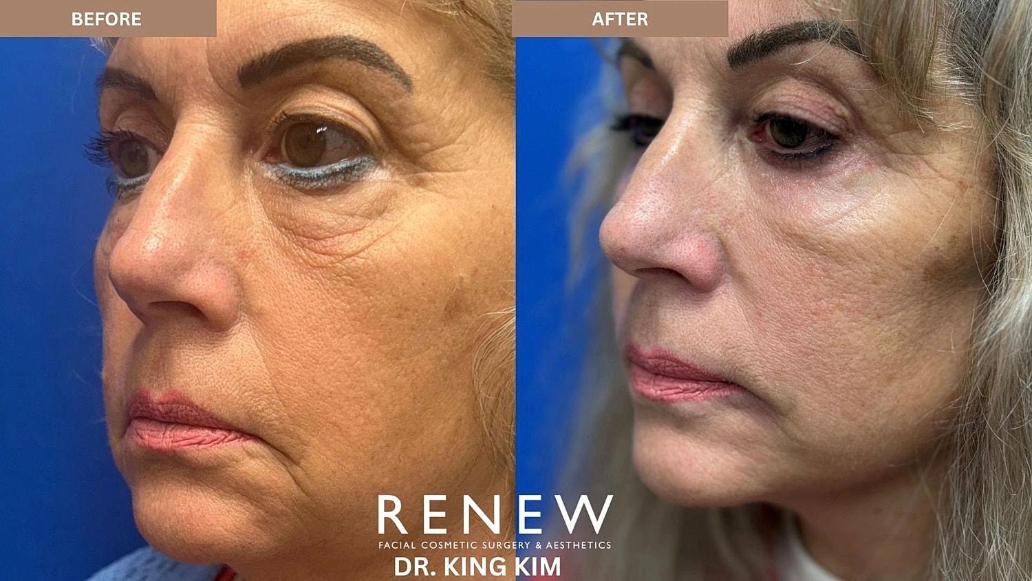 Brow Lift Before & After