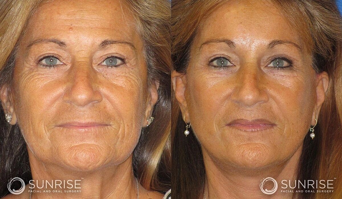 Brow Lift Before & After