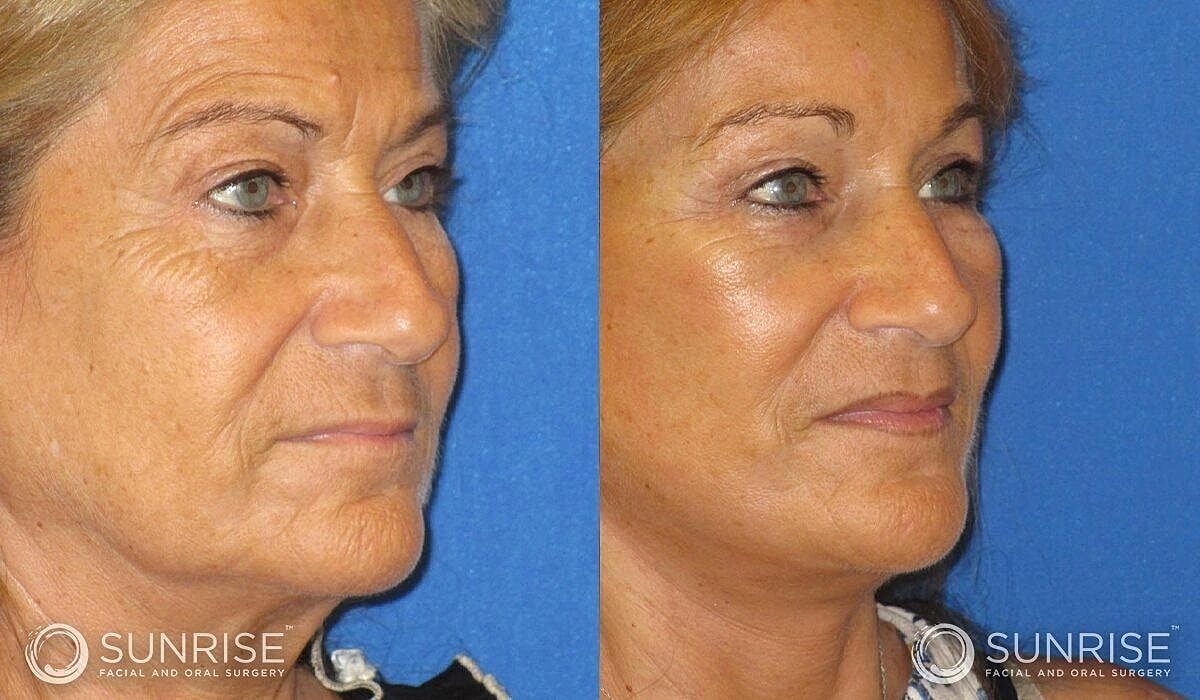 Brow Lift Before & After