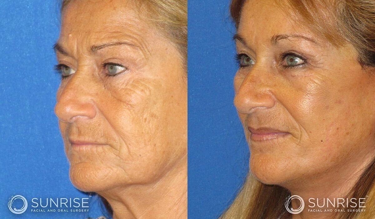 Brow Lift Before & After