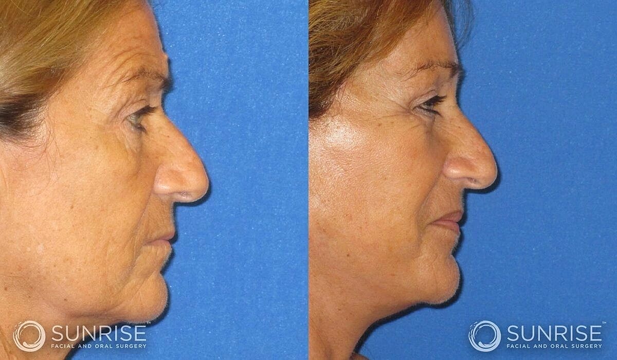 Brow Lift Before & After