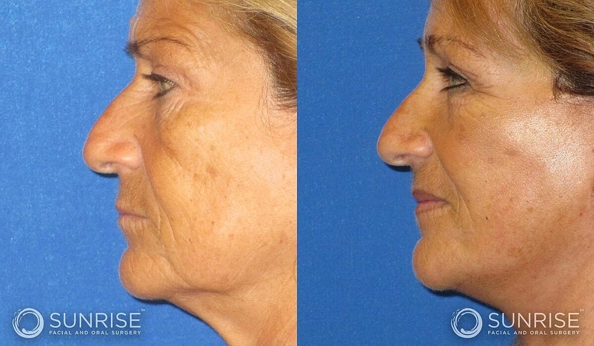 Brow Lift Before & After