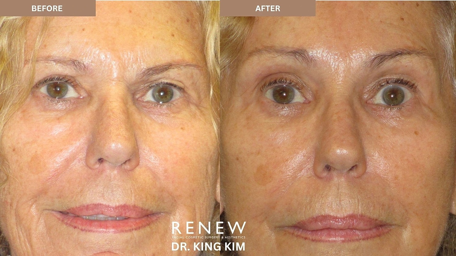 Brow Lift Before & After