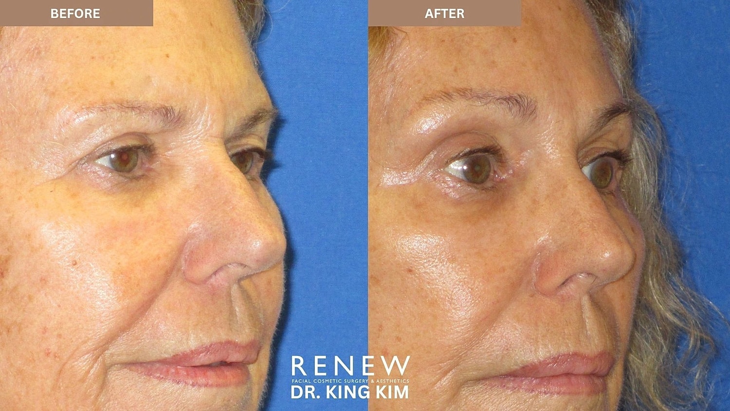 Brow Lift Before & After