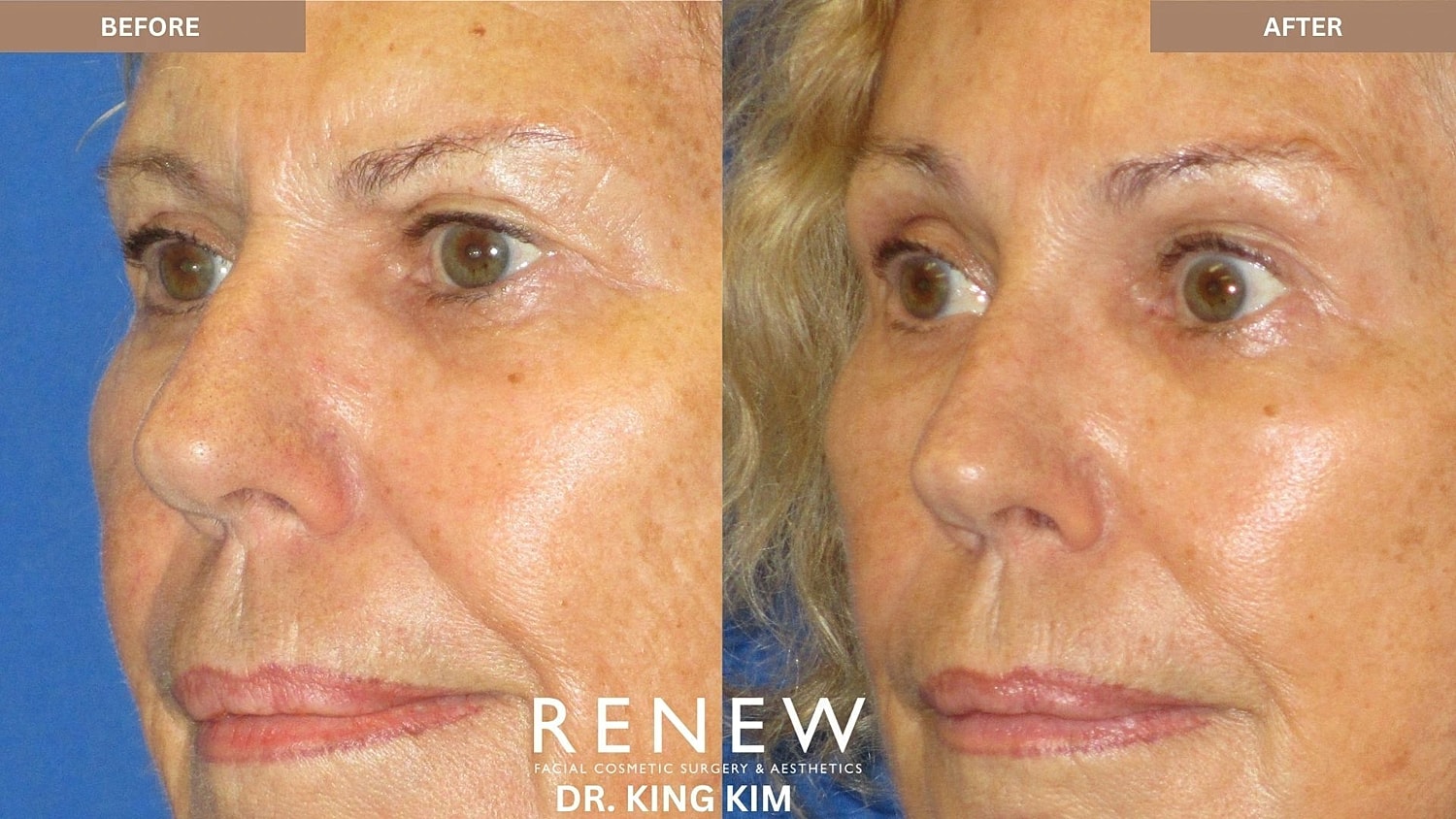 Brow Lift Before & After