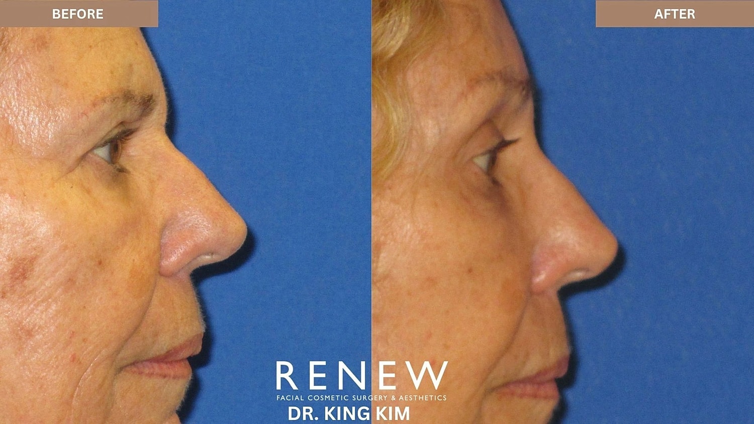 Brow Lift Before & After