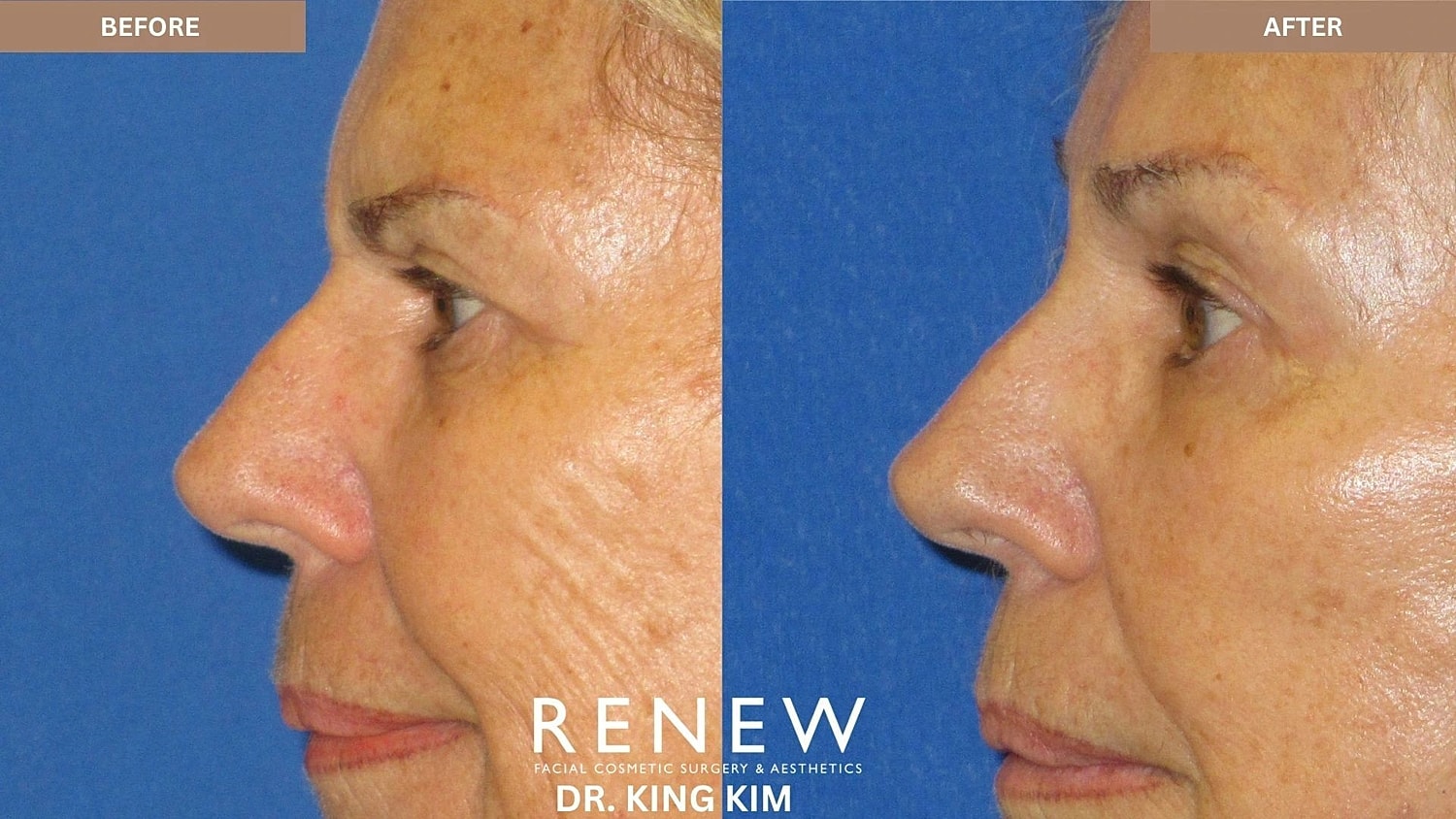 Brow Lift Before & After