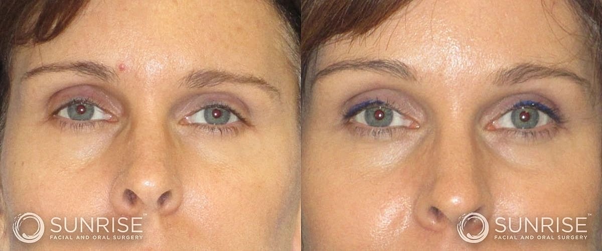 Brow Lift Before & After