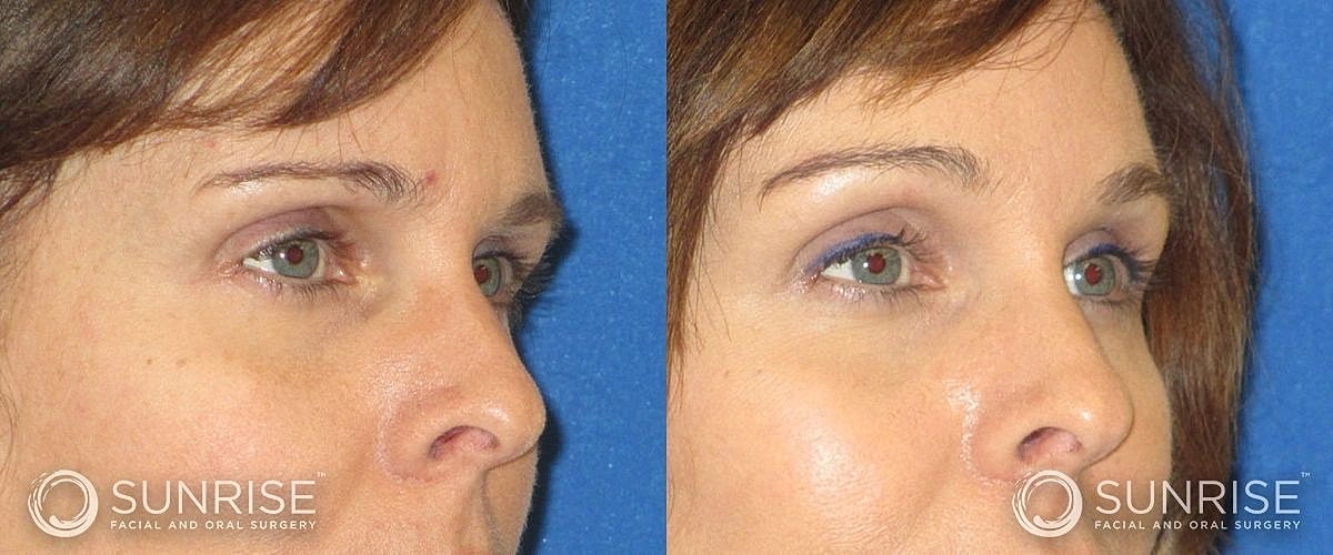 Brow Lift Before & After