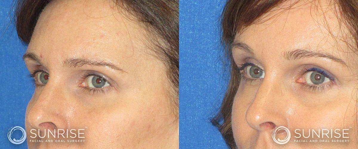 Brow Lift Before & After