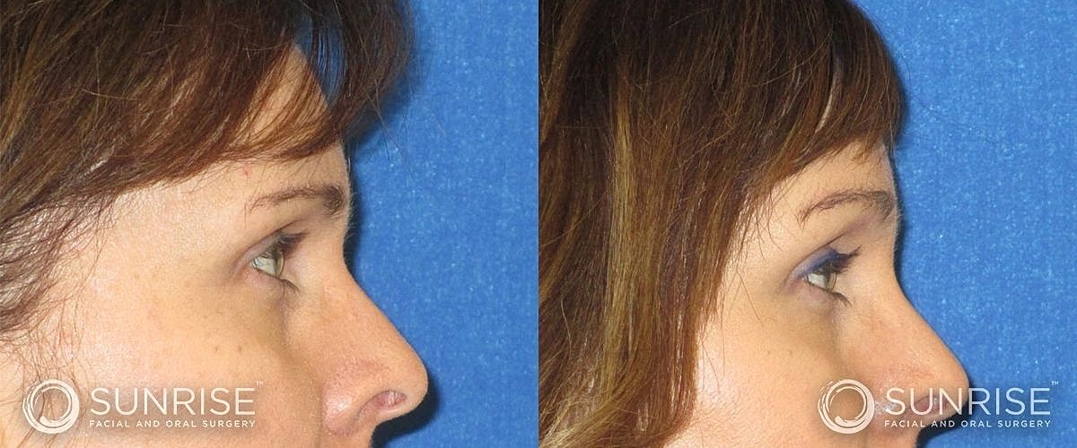 Brow Lift Before & After