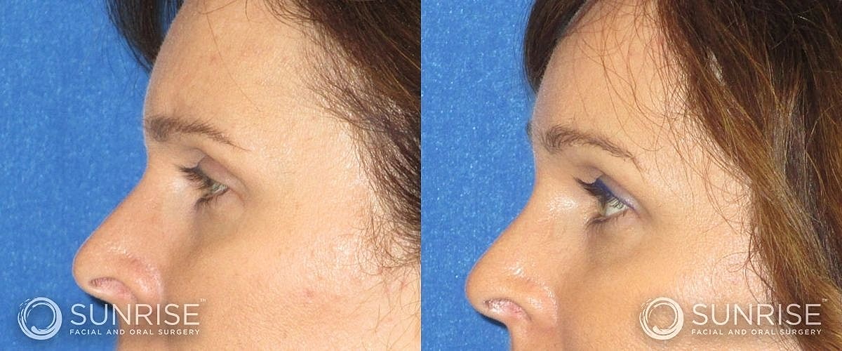 Brow Lift Before & After