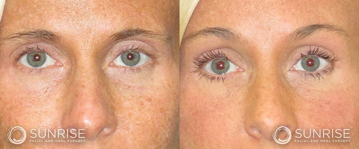 Brow Lift Before & After