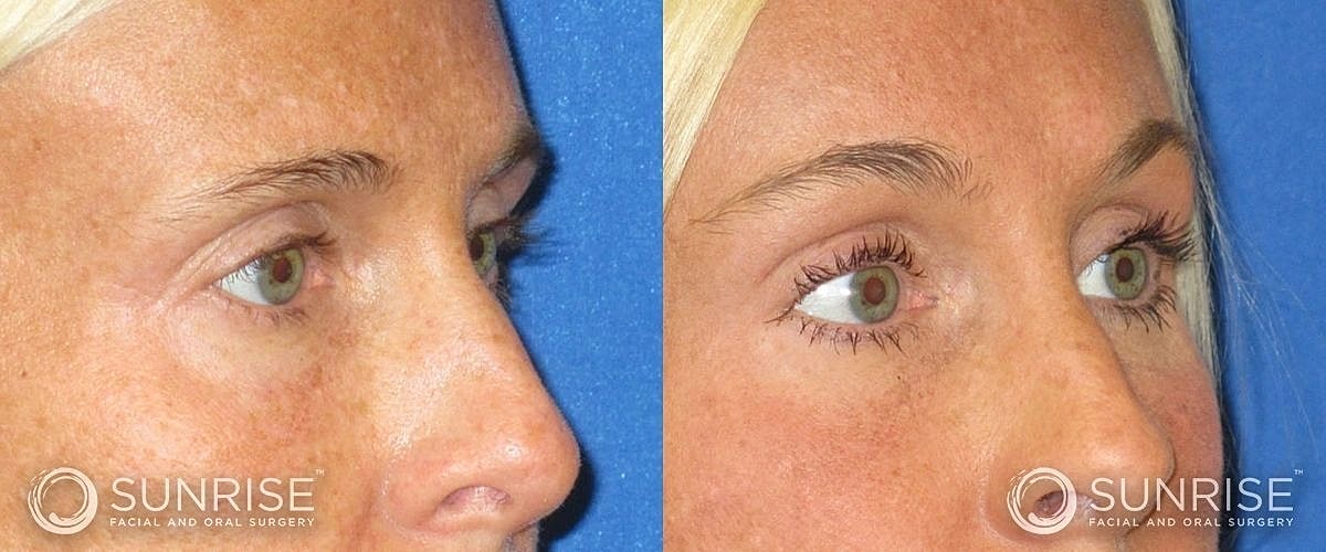Brow Lift Before & After