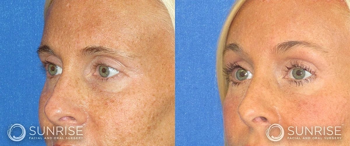 Brow Lift Before & After
