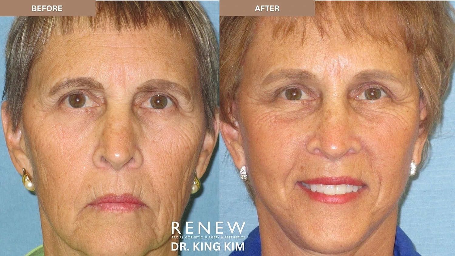 Brow Lift Before & After
