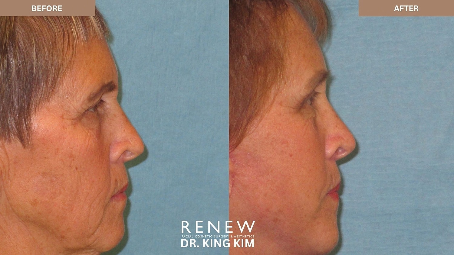 Brow Lift Before & After