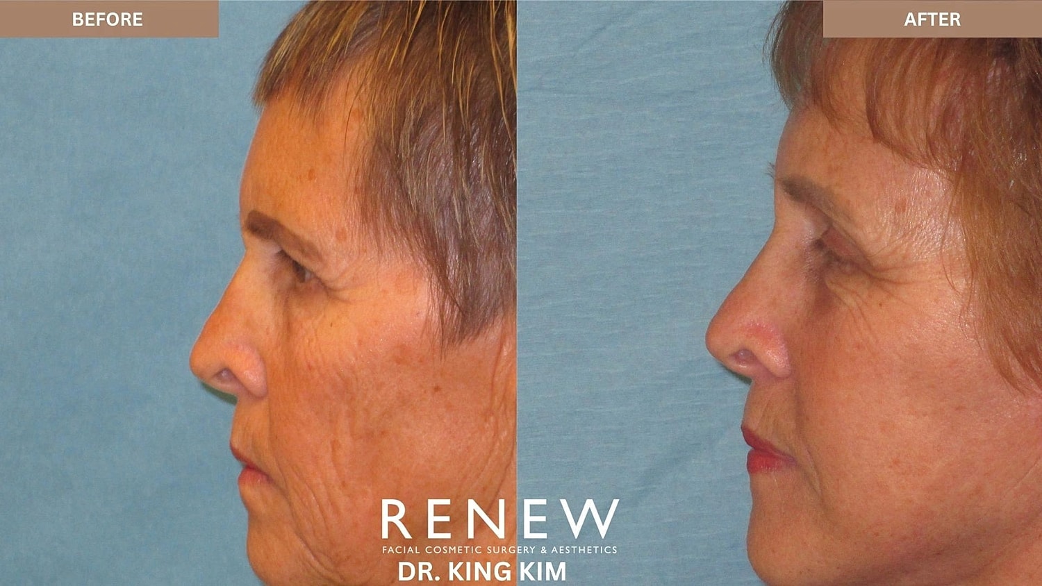 Brow Lift Before & After