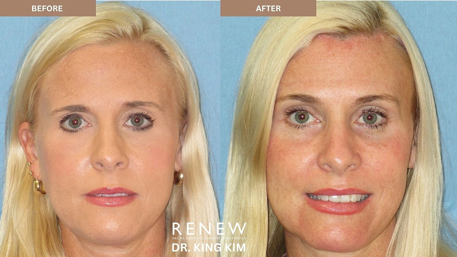 Brow Lift Before & After
