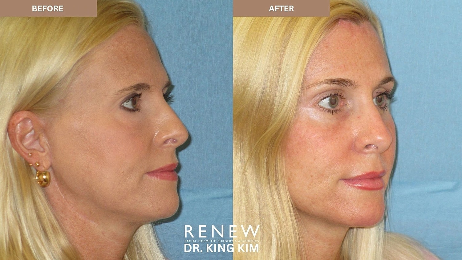 Brow Lift Before & After