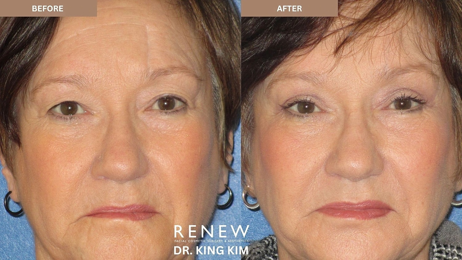 Blepharoplasty Before & After